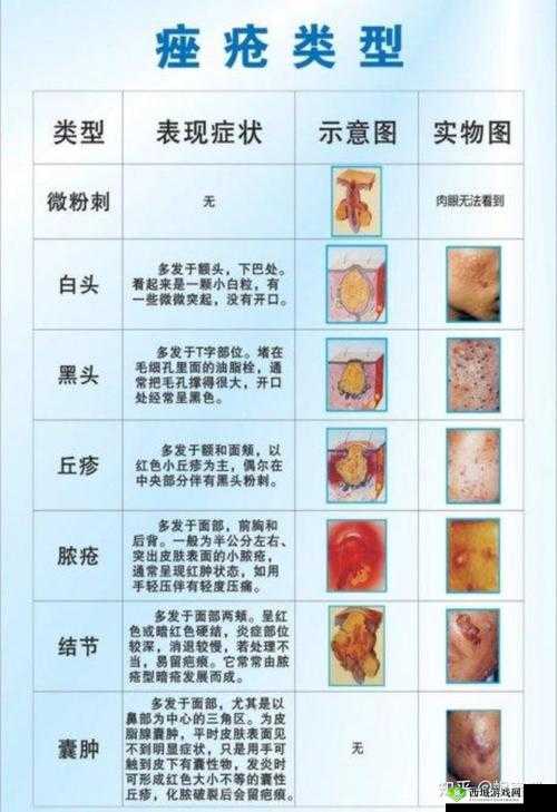 SP 发刷-红肿双丘成因及应对策略